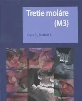 Tretie moláre (M3) - Vladimír Machoň, Dušan Hirjak
