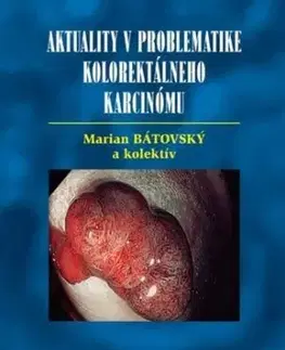 Aktuality v problematike kolorektálneho karcinómu - Marián Bátovský