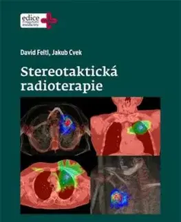 Stereotaktická radioterapie - Feltl David, Jakub Cvek