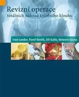 Revizní operace totálních náhrad kyčelního kloubu - Jiří Gallo, Ivan Landor, Pavel Vavřík