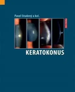 Keratokonus - Pavel Studený