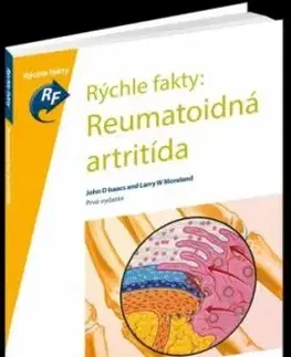 Rýchle fakty: Reumatoidná artritída