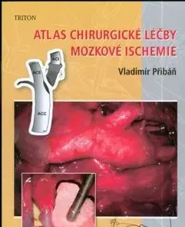 Atlas chirurgické léčby mozkové ischemie - Vladimír Přibáň