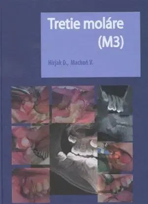 Tretie moláre (M3) - Vladimír Machoň, Dušan Hirjak