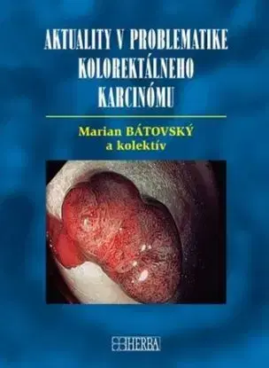 Aktuality v problematike kolorektálneho karcinómu - Marián Bátovský